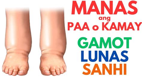 Pamamaga Ng Paa: Sanhi, Gamot, at Home Remedy Para Dito.